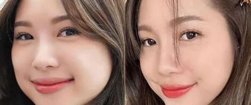Tiêm Botox Cân Chỉnh Khuôn Mặt