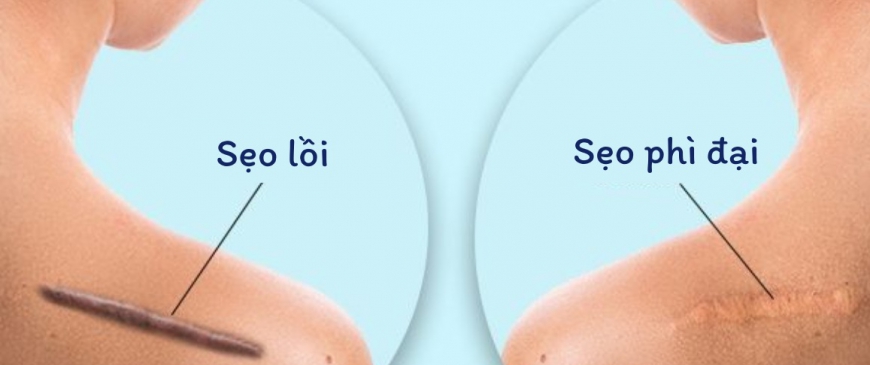Xử Lý Các Loại Sẹo