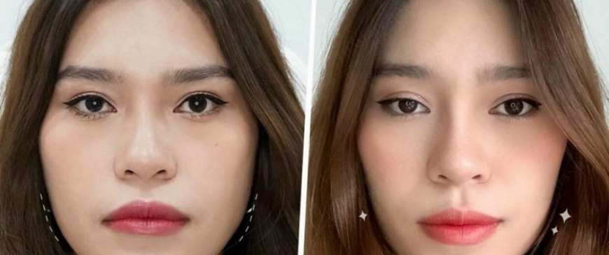 Tiêm Botox Gọn Hàm