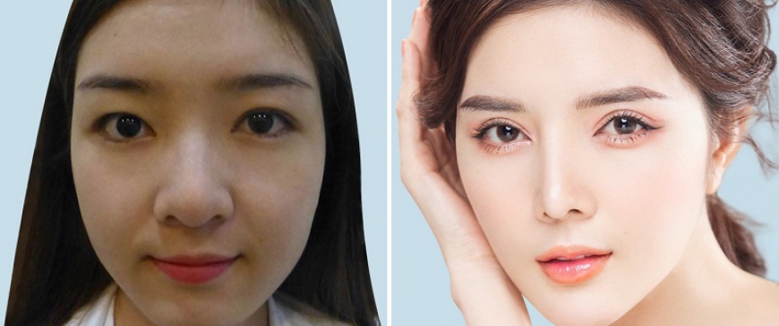Phẩu Thuật Cắt Mí Mắt