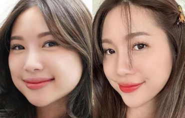 Tiêm Botox Cân Chỉnh Khuôn Mặt