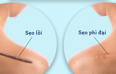 Xử Lý Các Loại Sẹo