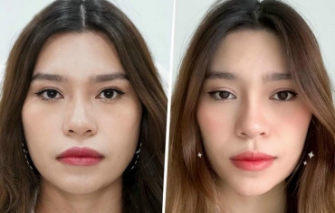 Tiêm Botox Gọn Hàm