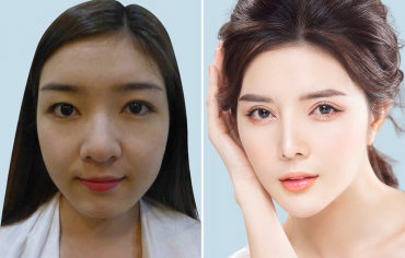Phẩu Thuật Cắt Mí Mắt