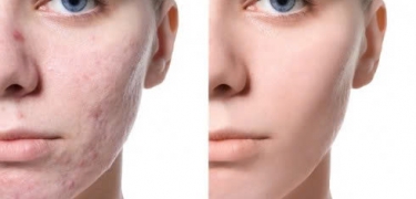 XỬ LÝ CÁC LOẠI SẸO